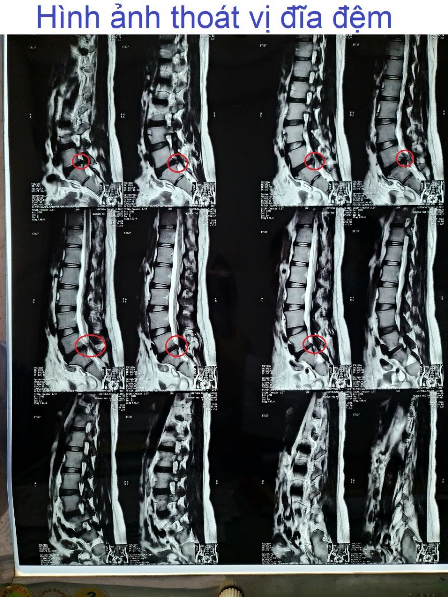 Hình ảnh thoát vị đĩa đệm